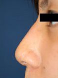 鼻の整形　写真　症例　施術前